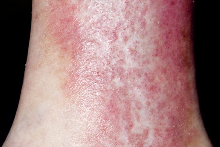 Preventing varicose eczema