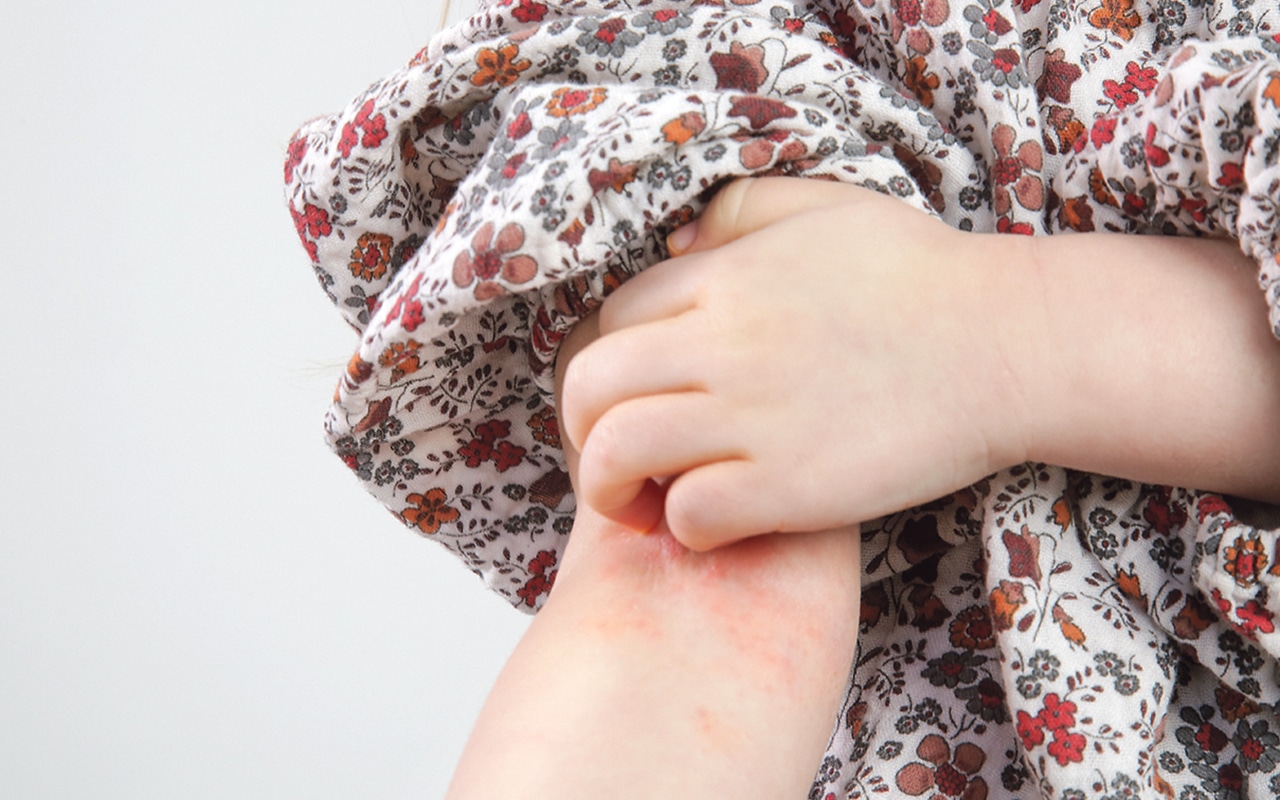 Easing eczema