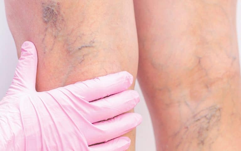 Natural approaches for varicose veins