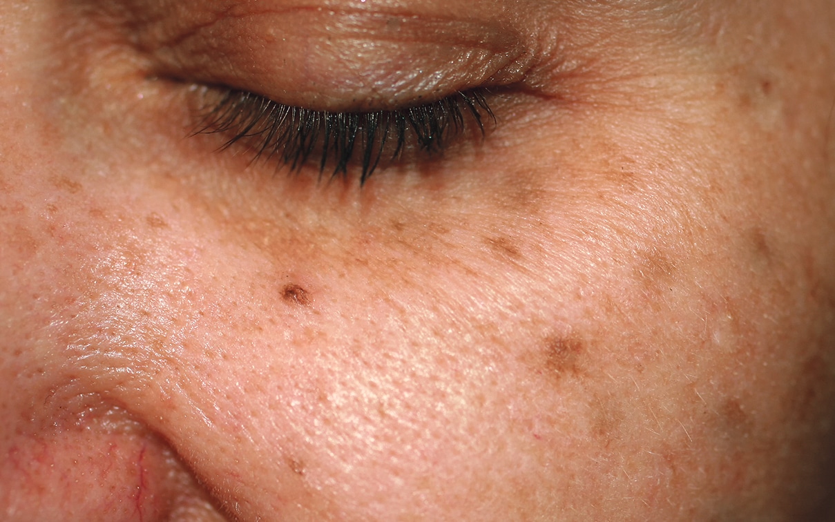 Caring for skin with sun damage