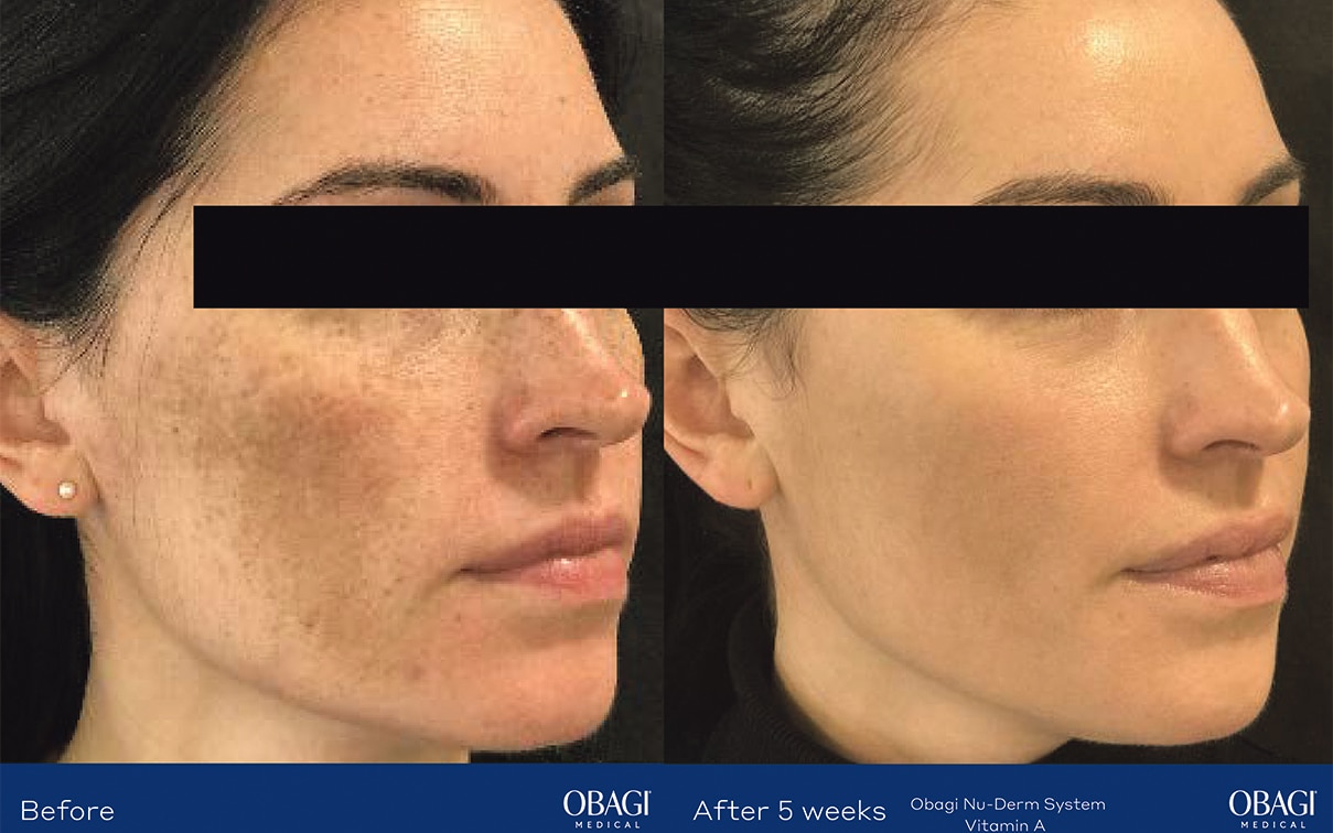 Understanding pigmentation and how to treat it